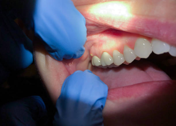 Urgent Tooth Repair in LA